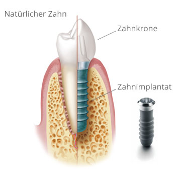 Grafik natürlicher Zahn und Implantat