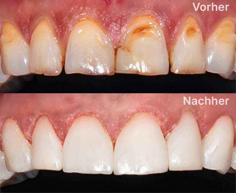 Kompositfüllungen Vorher – Nachher